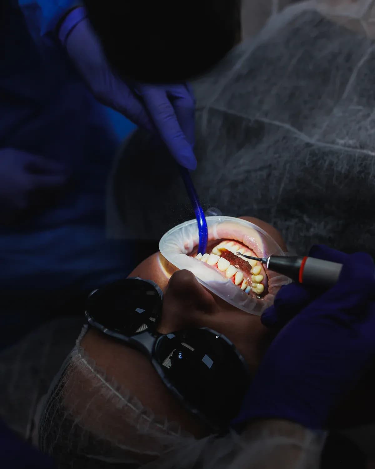 Aplicação do gel clareador sobre os dentes, com afastador e barreira gengival
